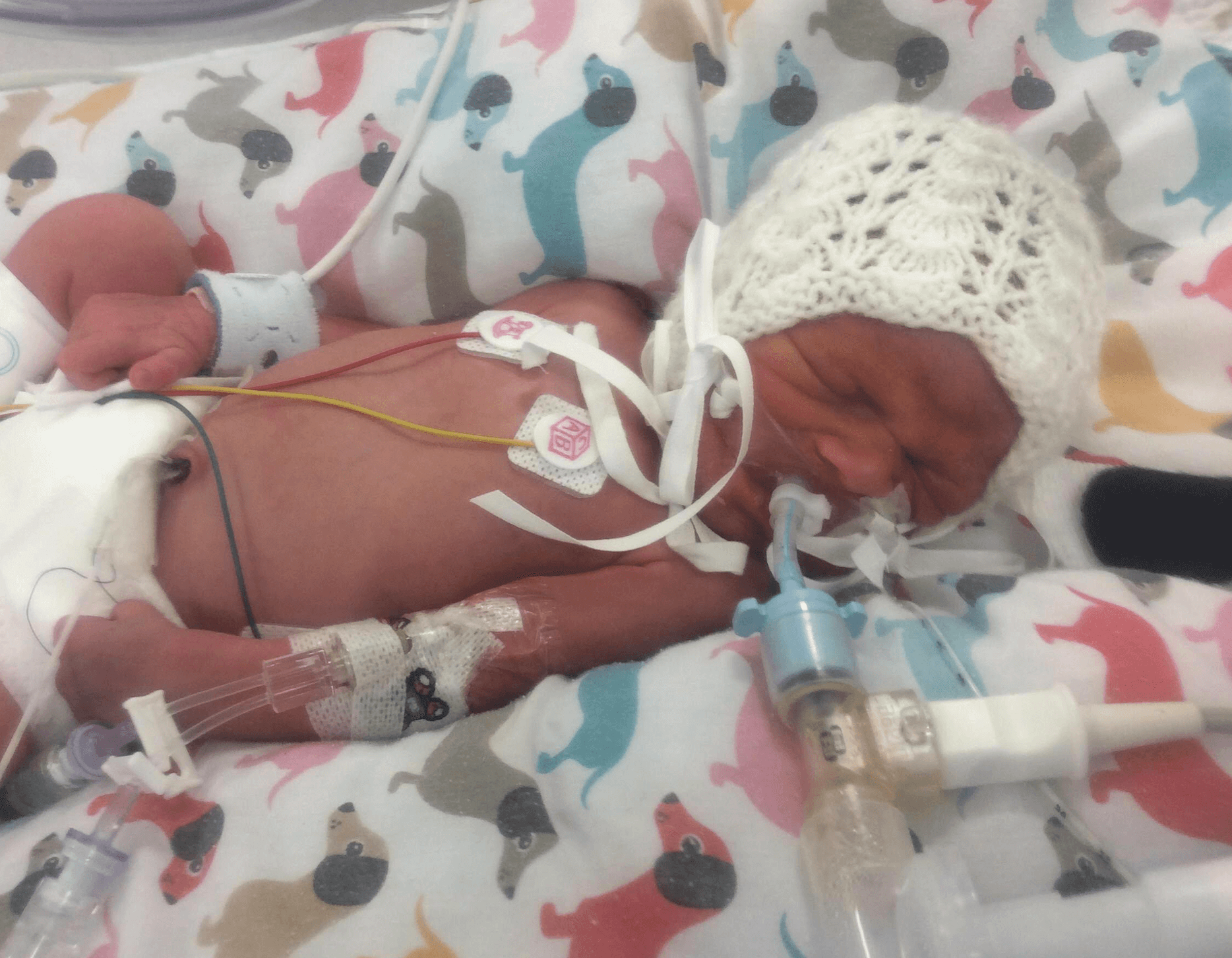 Having a premature baby