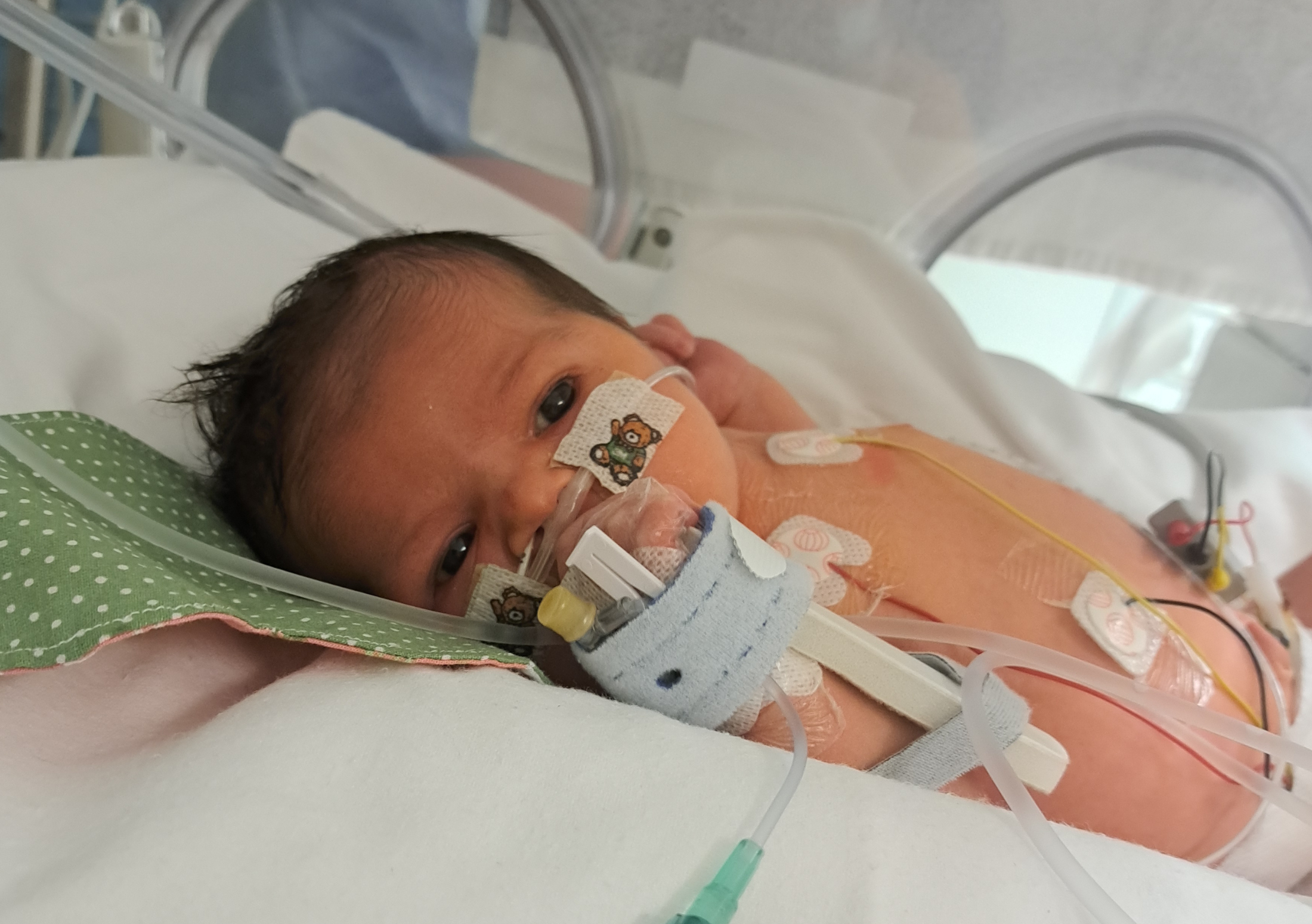 Baby Opal being tube-fed in an incubator