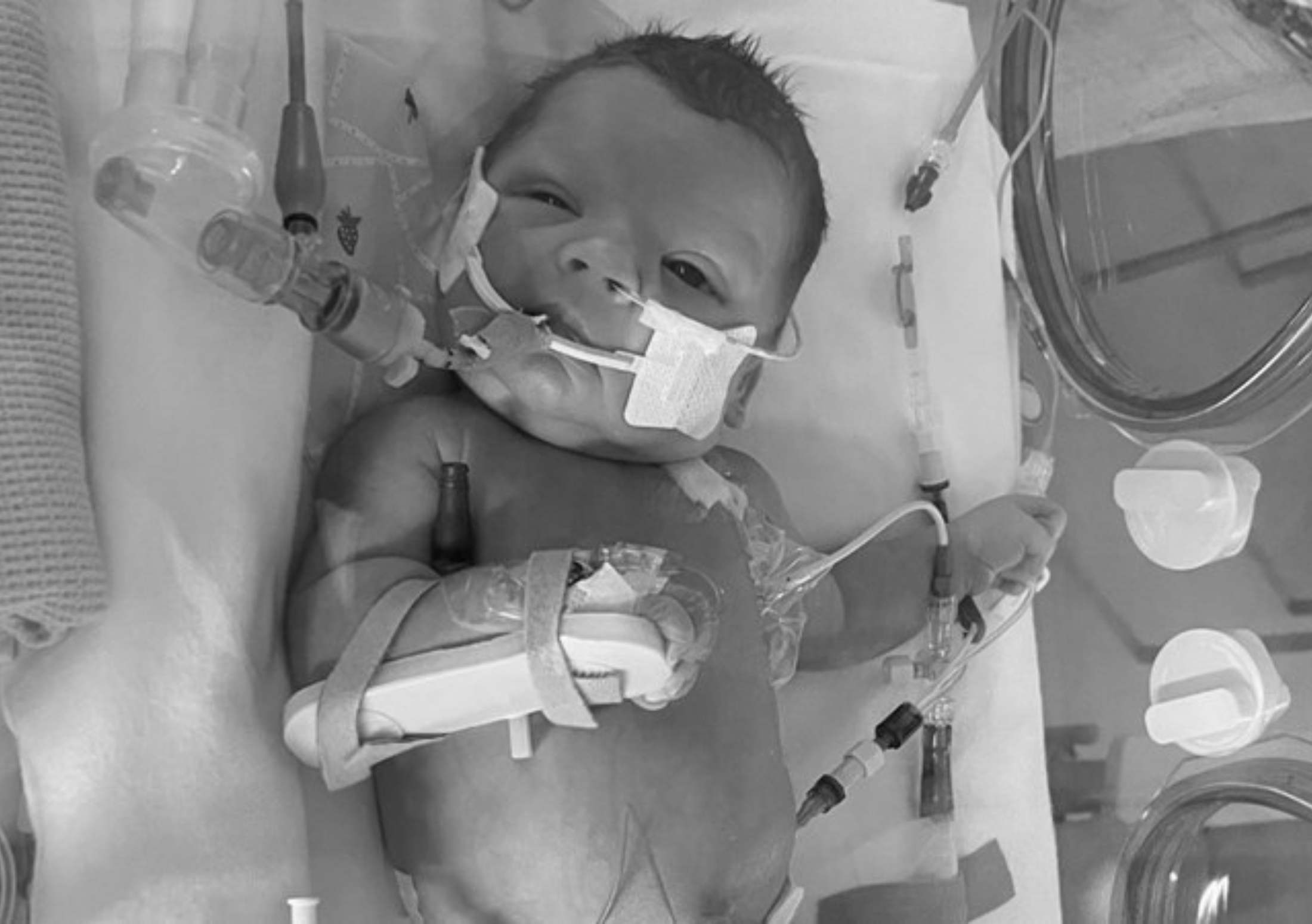 Premature baby in NICU