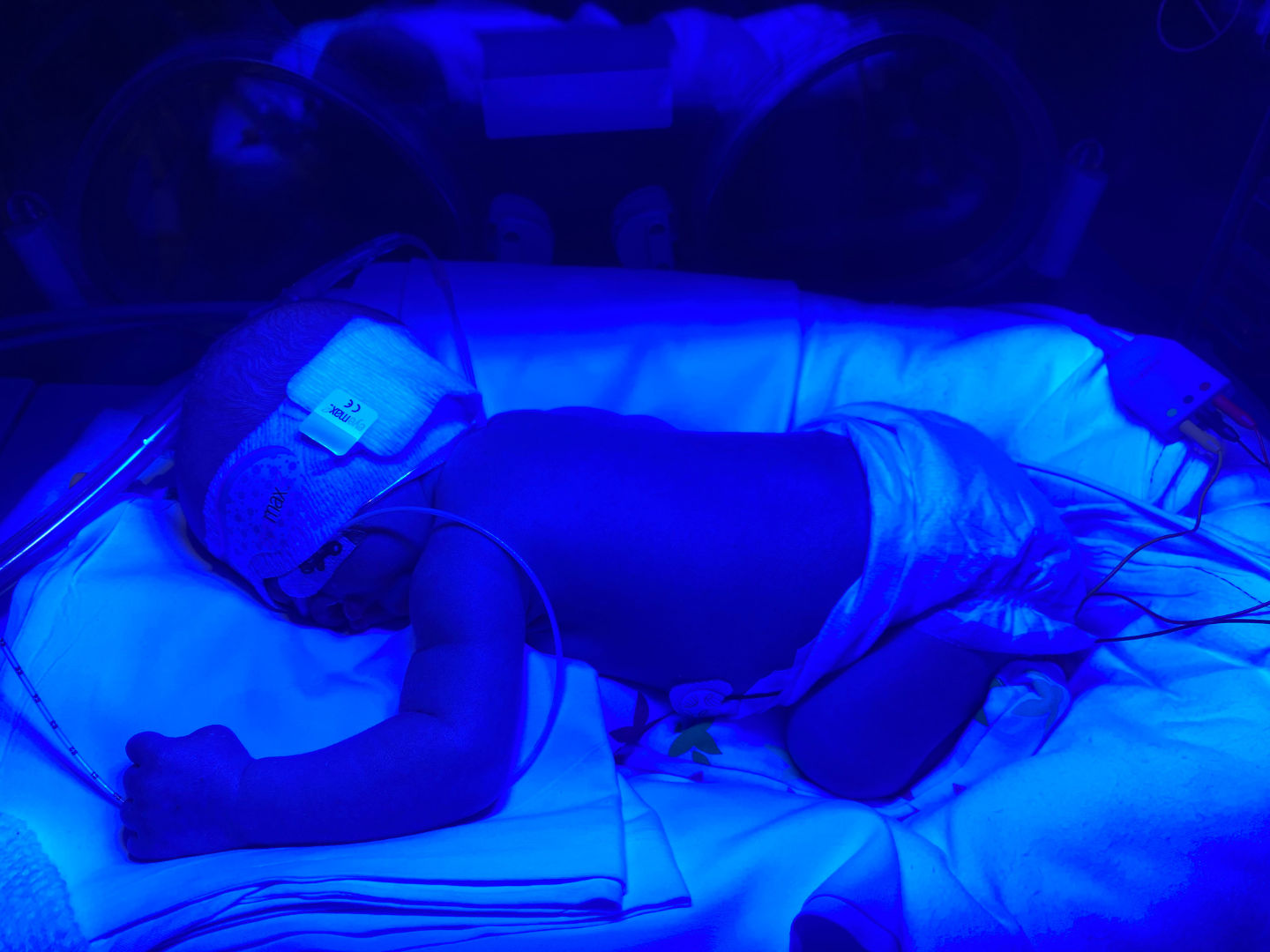 Baby Bodhi being treated for Jaundice