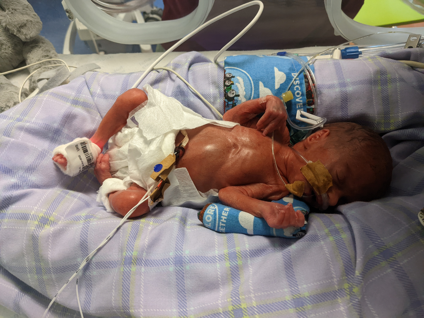 NICU baby Phoebe
