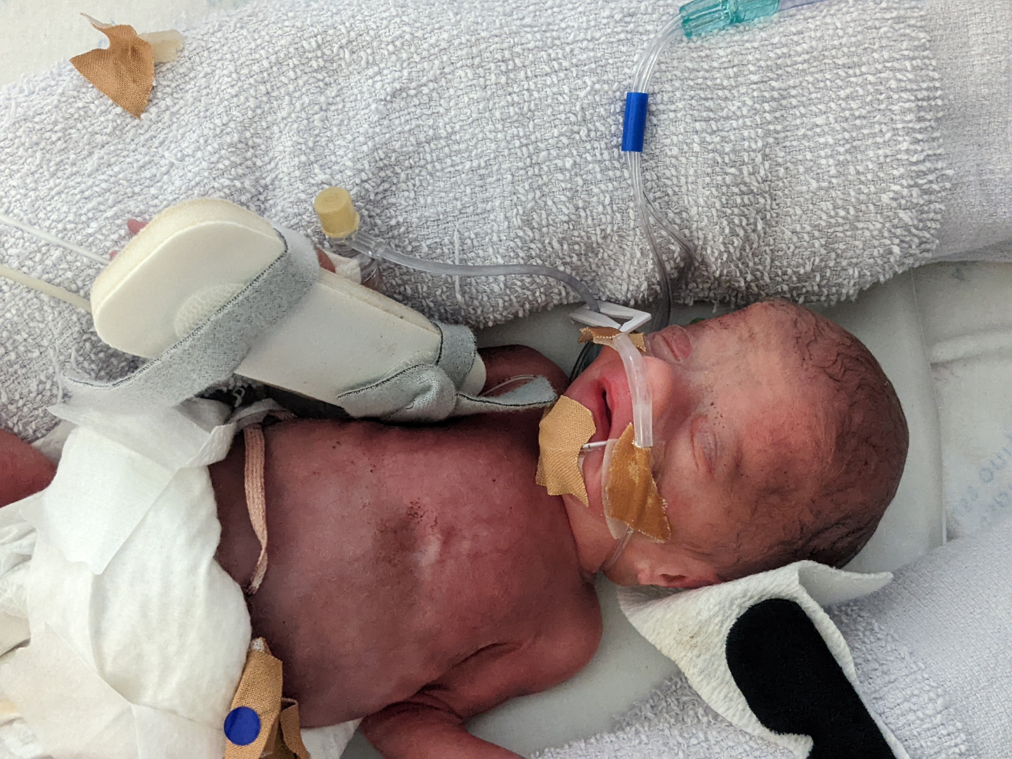 NICU baby Phoebe